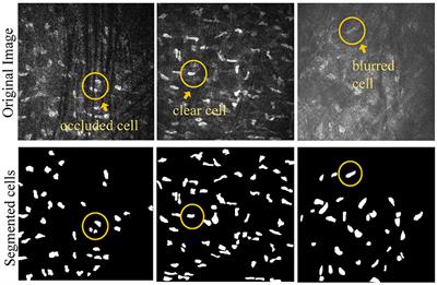 U-NTCA: nnUNet and nested transformer with channel attention for corneal cell segmentation